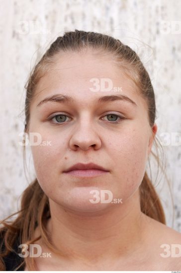 Head Woman White Birthmarks Overweight