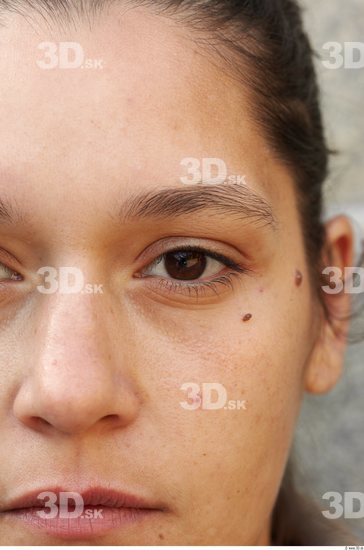 Eye Woman White Birthmarks Average