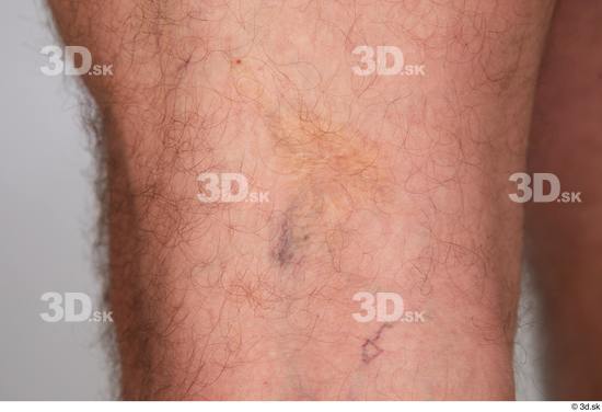 Neeo broken blood vessels knee skin  jpg