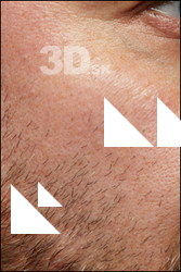 Neeo HD Face Skin
